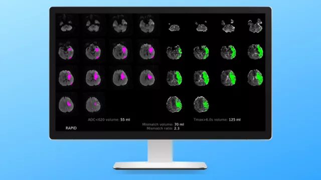 La inteligencia artificial llega a salvar vidas y mejorar secuelas de los ACV (un software que "lee" mejor que los médicos)